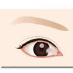 サーファーがなりやすい目の病気『翼状片』とは？原因や治療・予防法は？