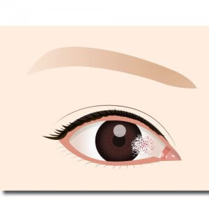 サーファーがなりやすい目の病気『翼状片』とは？原因や治療・予防法は？